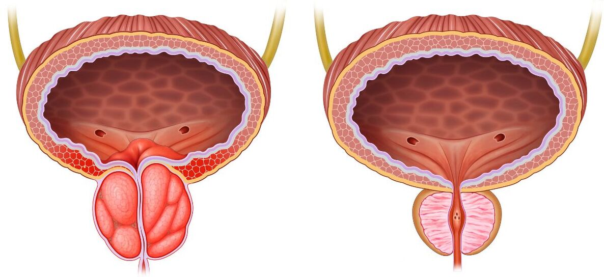 prostata osasuntsua eta gaixoa