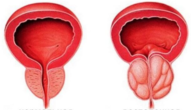 Prostatitis kronikoa