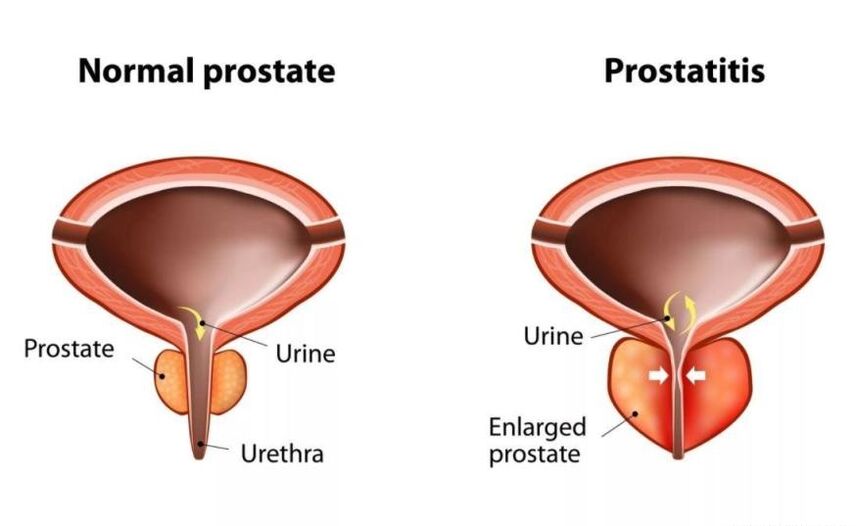 Prostata normala eta hantura