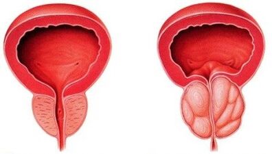 Prostatitis osasuntsua eta hantura